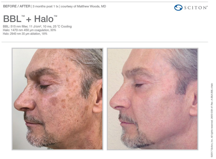 BBL and Halo before and after photo by Midwest Facial Plastic Surgery