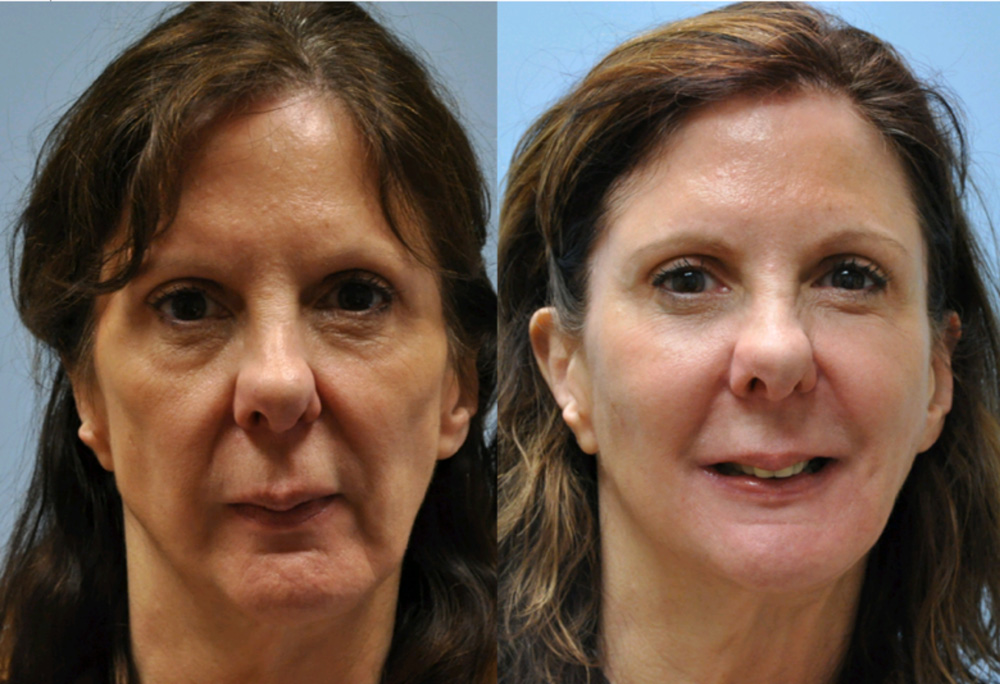 Dermal Filler before and after photo by Dr. Garrett Griffin