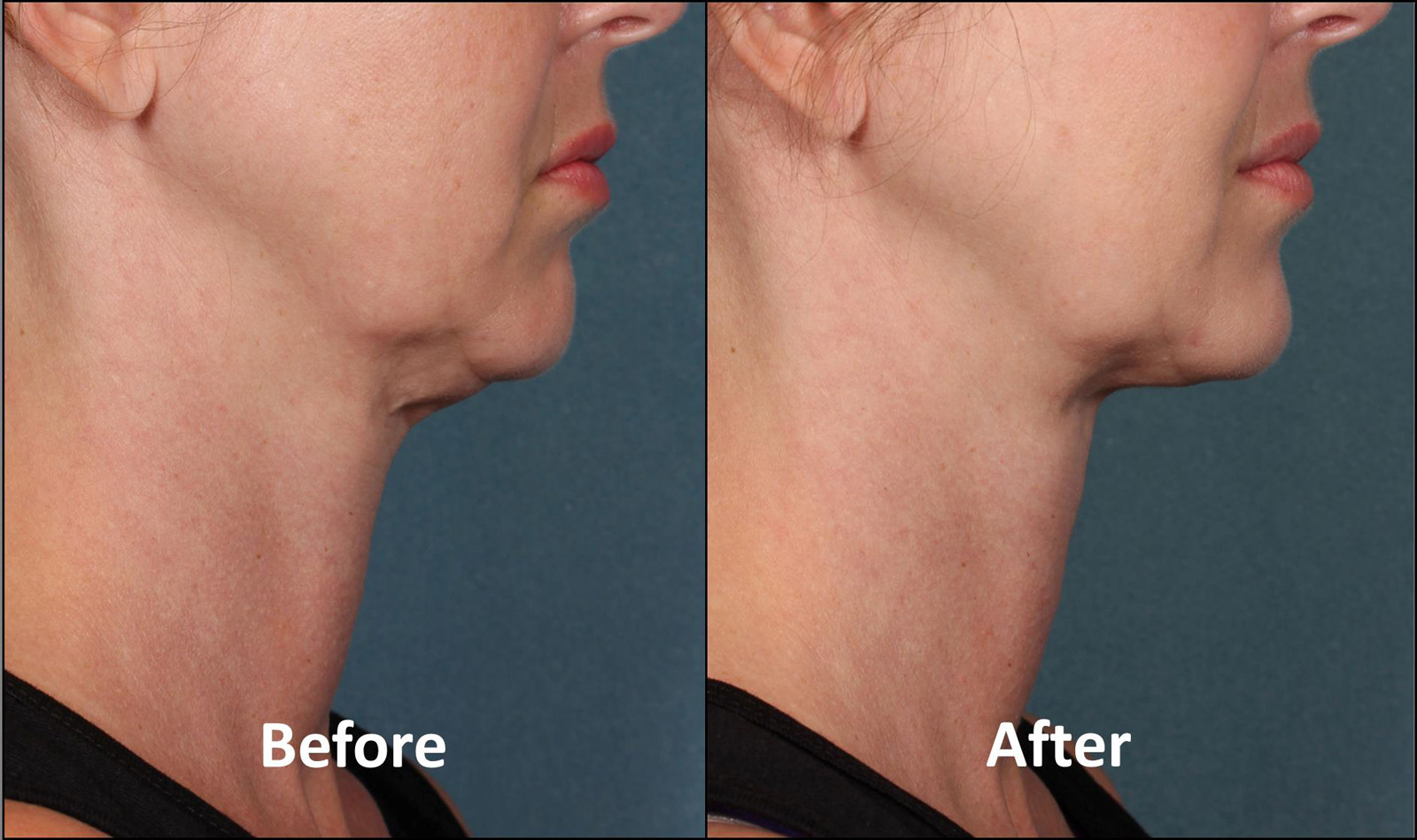 Kybella Injectable for Submental Region before and after photo by Midwest Facial Plastic Surgery & Esthetic Skincare