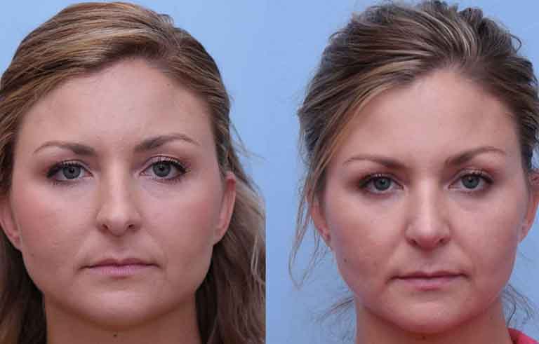 Rhinoplasty before and after photo by Midwest Facial Plastic Surgery in Minnesota