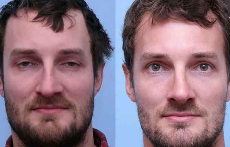 Rhinoplasty before and after photo by Midwest Facial Plastic Surgery in Minnesota