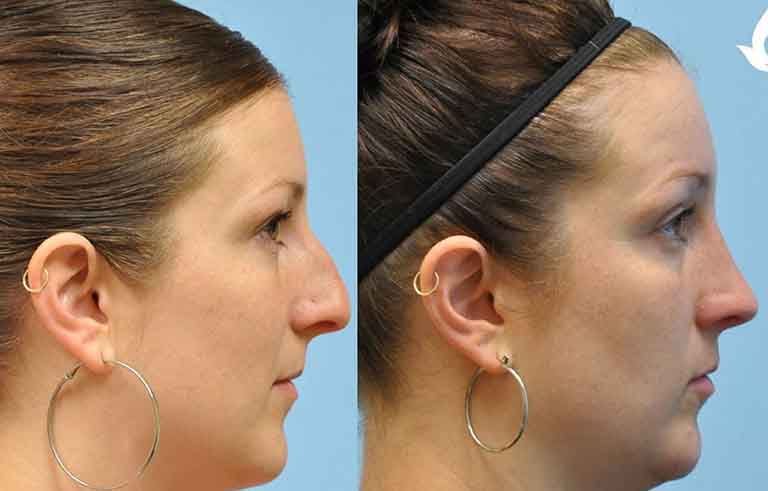 Rhinoplasty before and after photo by Midwest Facial Plastic Surgery in Minnesota