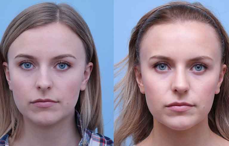 Rhinoplasty before and after photo by Midwest Facial Plastic Surgery in Minnesota