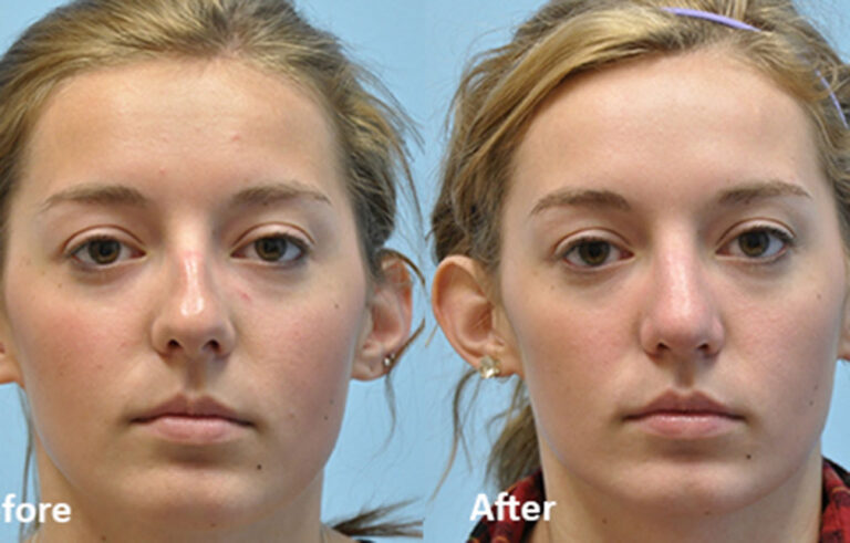 Rhinoplasty before and after photo by Midwest Facial Plastic Surgery in Minnesota