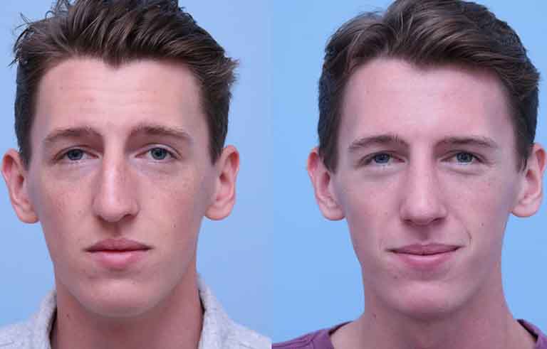 Rhinoplasty before and after photo by Midwest Facial Plastic Surgery in Minnesota