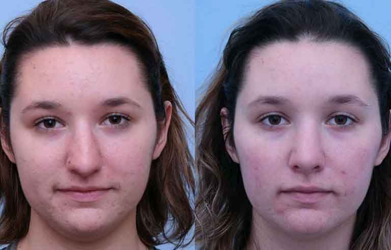 Rhinoplasty before and after photo by Midwest Facial Plastic Surgery in Minnesota