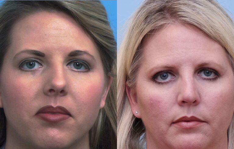Rhinoplasty before and after photo by Midwest Facial Plastic Surgery in Minnesota