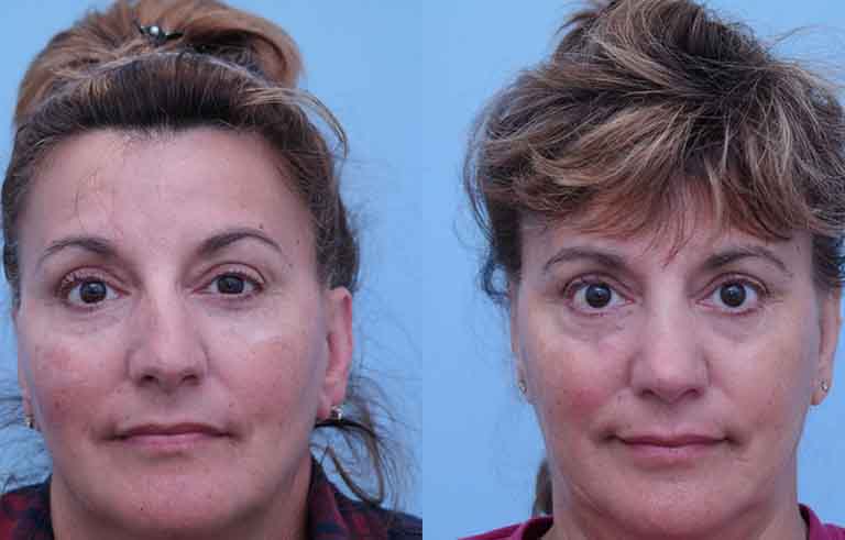 Rhinoplasty before and after photo by Midwest Facial Plastic Surgery in Minnesota