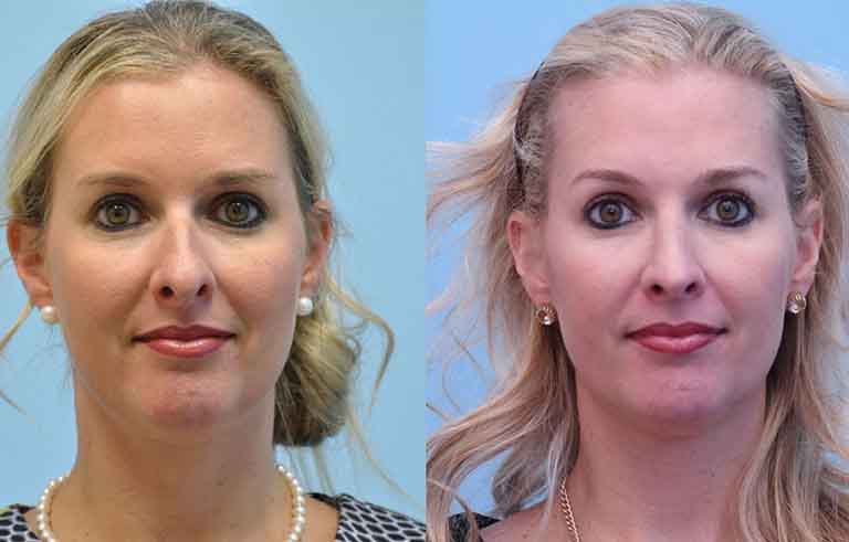 Rhinoplasty before and after photo by Midwest Facial Plastic Surgery in Minnesota