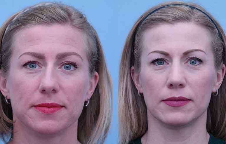 Rhinoplasty before and after photo by Midwest Facial Plastic Surgery in Minnesota