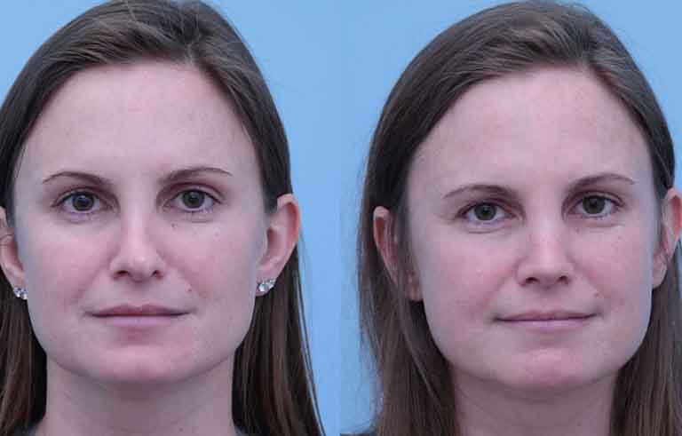 Rhinoplasty before and after photo by Midwest Facial Plastic Surgery in Minnesota
