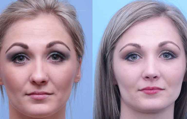 Rhinoplasty before and after photo by Midwest Facial Plastic Surgery in Minnesota