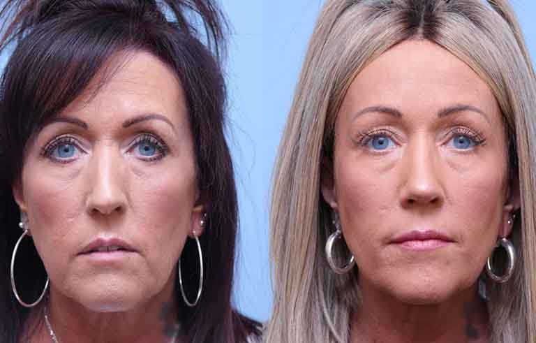 Rhinoplasty before and after photo by Midwest Facial Plastic Surgery in Minnesota