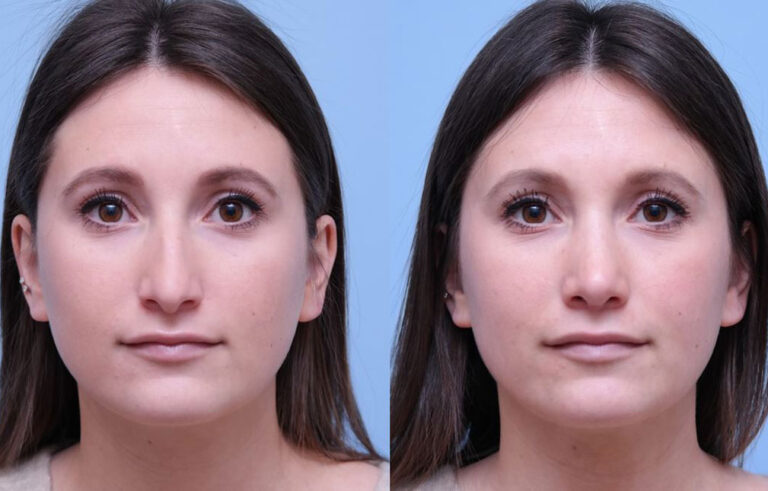 Rhinoplasty before and after photo by Midwest Facial Plastic Surgery in Minnesota