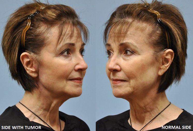 Facial Symmetry After Cancer before and after photo by Midwest Facial Plastic Surgery