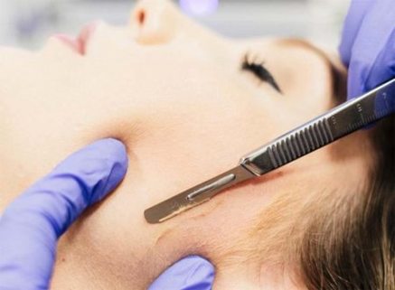 Female patient getting Dermablading on her sideburns