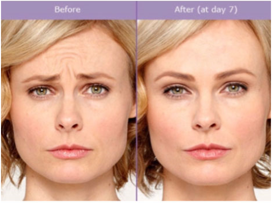 Dermal filler before and after photo by Midwest Facial Plastic Surgery & Esthetic Skincare