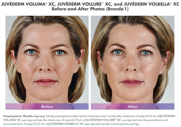 Dermal filler before and after photo by Midwest Facial Plastic Surgery & Esthetic Skincare