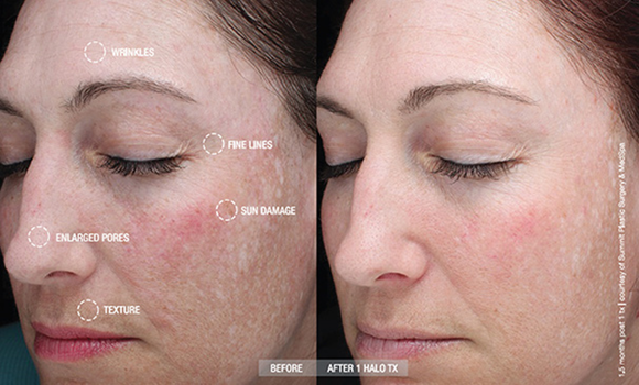 Halo treatment before and after photo by Midwest Facial Plastic Surgery & Esthetic Skincare