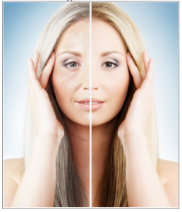 Dermal Fillers Before and After photo