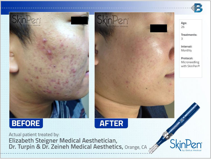 Microneedling before and after photo by Midwest Facial Plastic Surgery