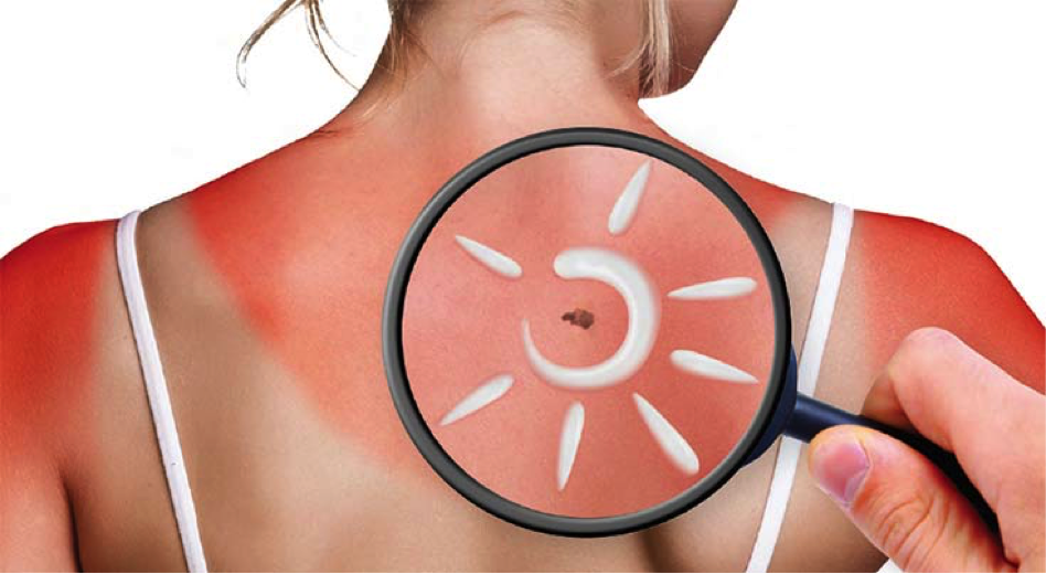 Sunburn on woman's back