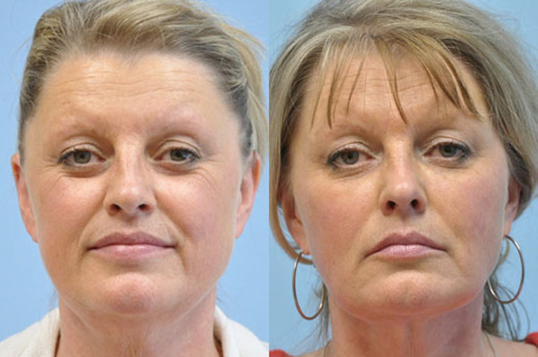 Midwest Facial Plastic Surgery before and after gallery images