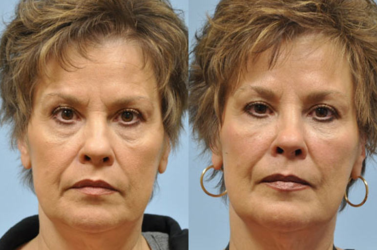 Midwest Facial Plastic Surgery before and after gallery images