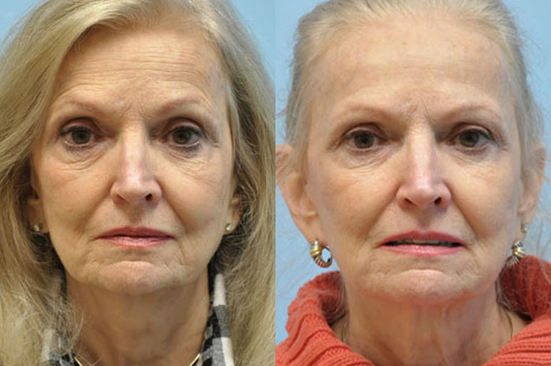 Midwest Facial Plastic Surgery before and after gallery images