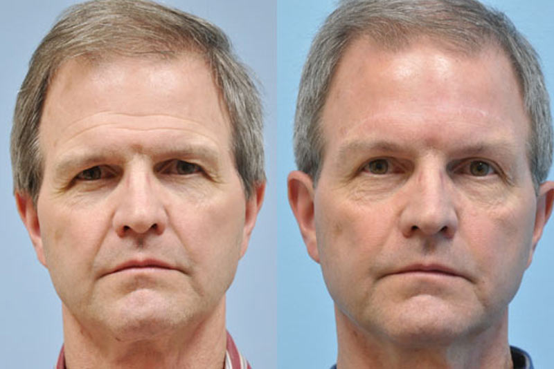eyelid lift before and after gallery image