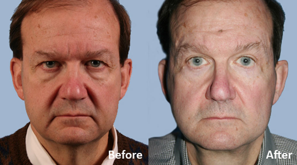 facelift before and after gallery images