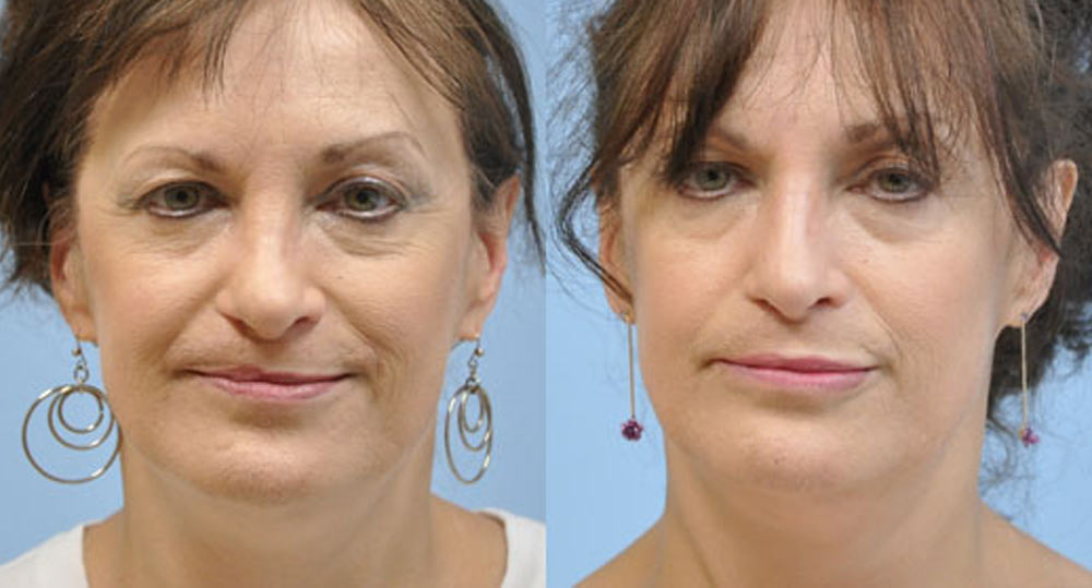 facial surgery before and after image