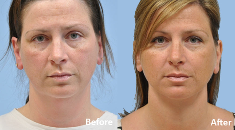 neck lift before and after gallery images