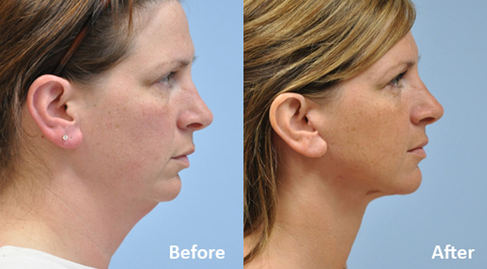 neck lift before and after gallery images