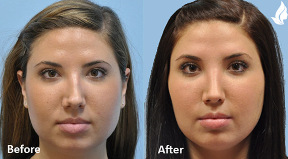 rhinoplasty before and after gallery images