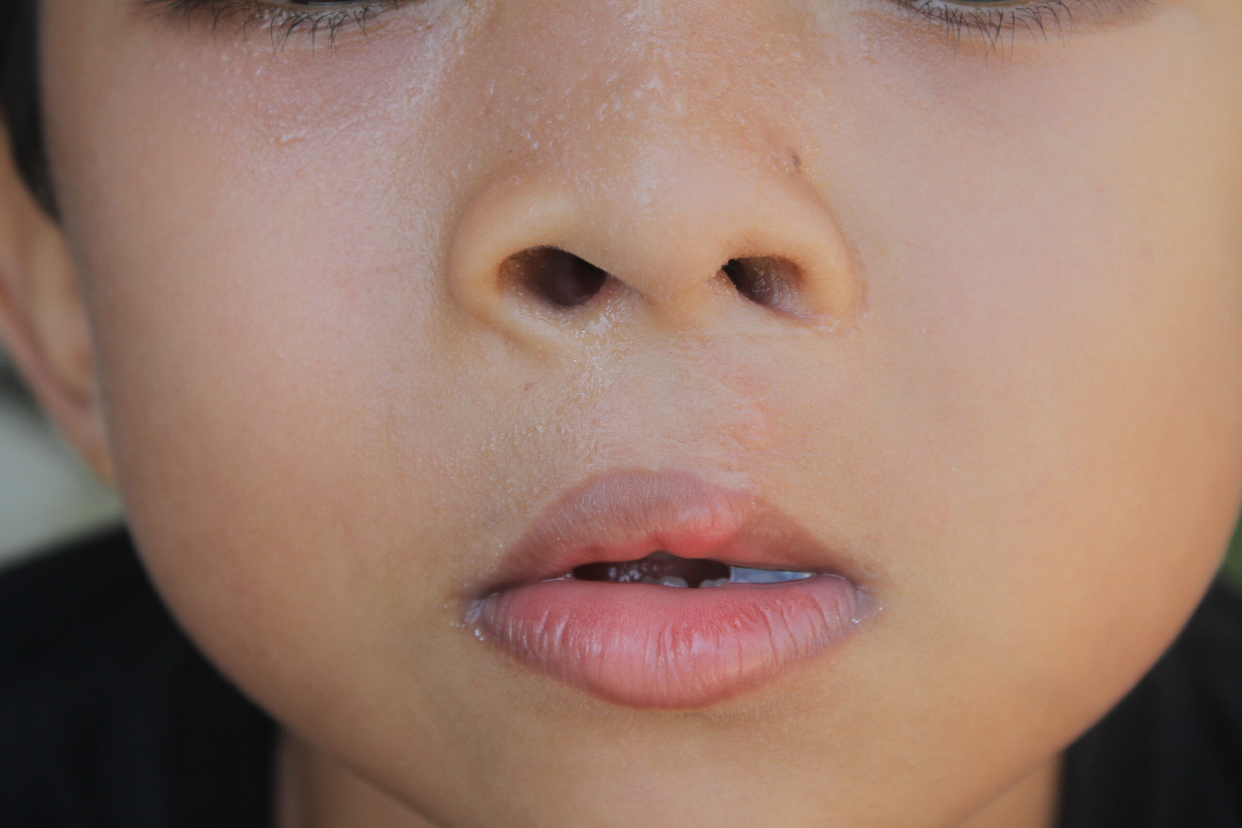 condition of nose and lips after cleft lip surgery in children