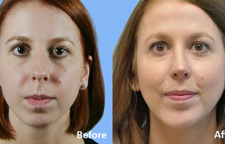 Rhinoplasty before and after photo by Midwest Facial Plastic Surgery in Minnesota