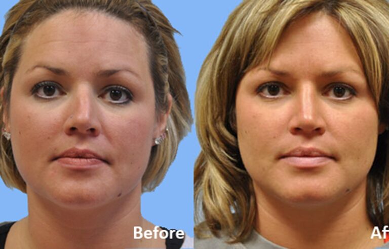 Rhinoplasty before and after photo by Midwest Facial Plastic Surgery in Minnesota