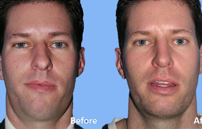 Rhinoplasty before and after photo by Midwest Facial Plastic Surgery in Minnesota