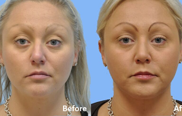 Rhinoplasty before and after photo by Midwest Facial Plastic Surgery in Minnesota