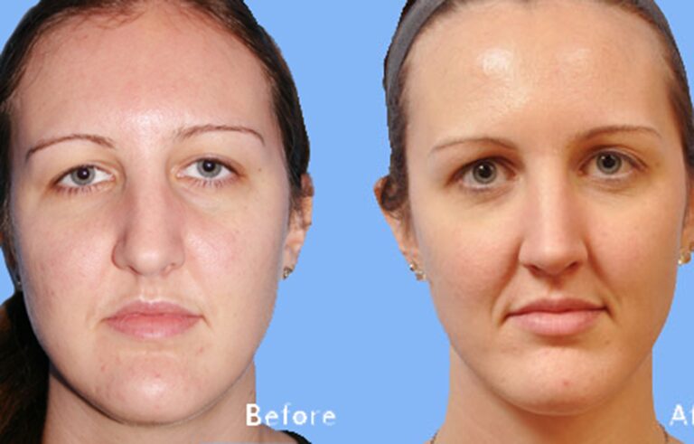 Rhinoplasty before and after photo by Midwest Facial Plastic Surgery in Minnesota