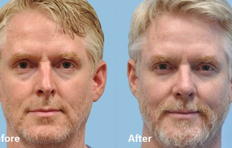 Rhinoplasty before and after photo by Midwest Facial Plastic Surgery in Minnesota