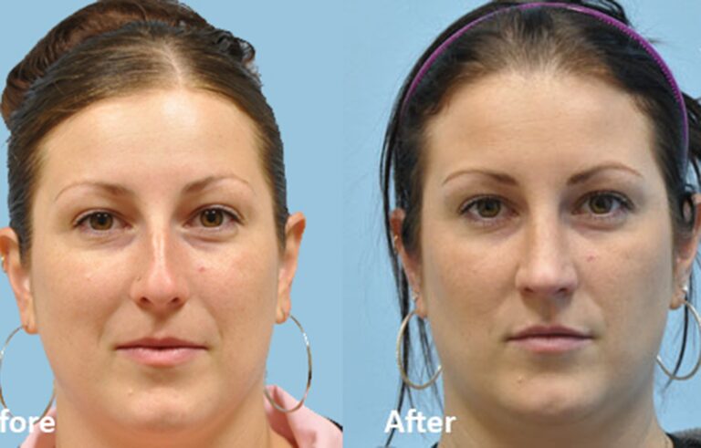 Rhinoplasty before and after photo by Midwest Facial Plastic Surgery in Minnesota