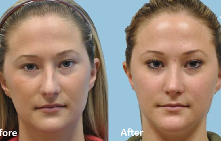 Rhinoplasty before and after photo by Midwest Facial Plastic Surgery in Minnesota