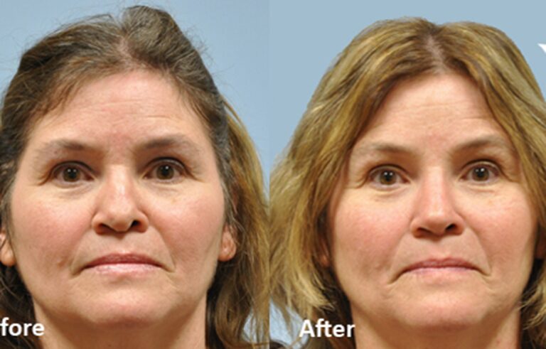 Rhinoplasty before and after photo by Midwest Facial Plastic Surgery in Minnesota