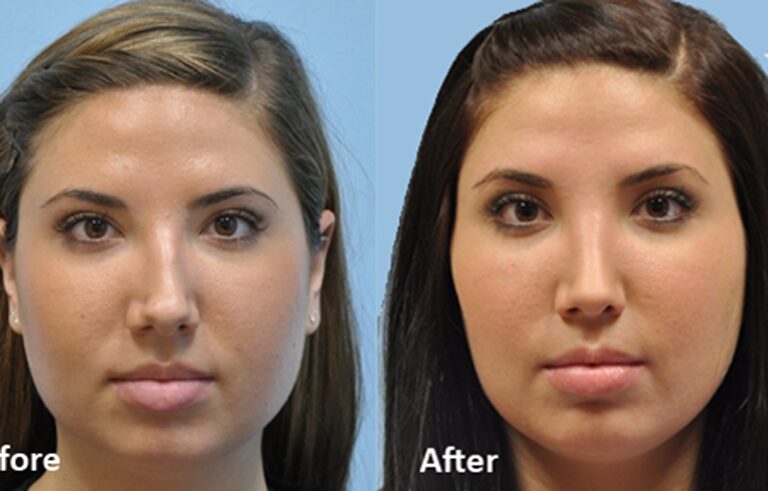 Rhinoplasty before and after photo by Midwest Facial Plastic Surgery in Minnesota
