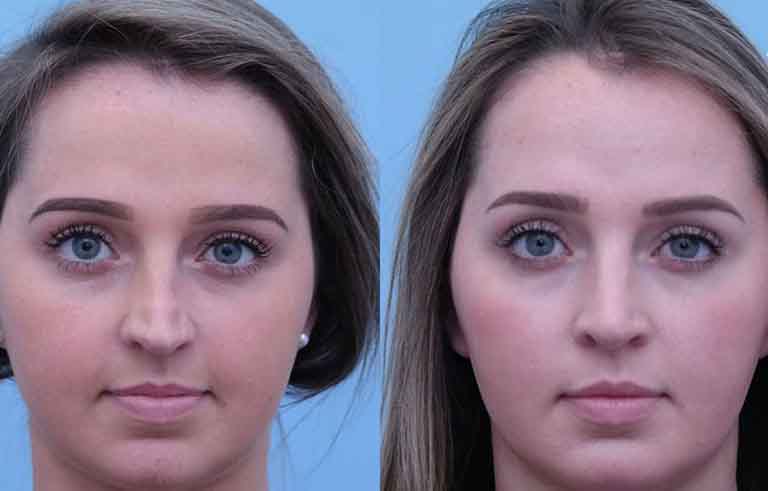 Rhinoplasty before and after photo by Midwest Facial Plastic Surgery in Minnesota