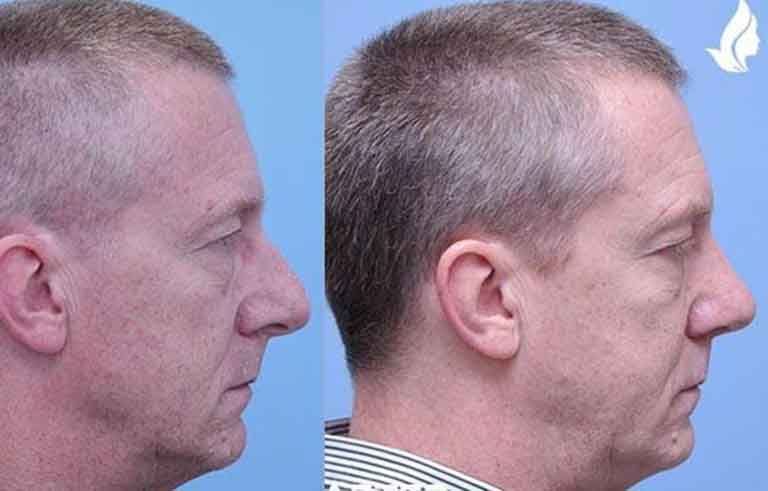 Rhinoplasty before and after photo by Midwest Facial Plastic Surgery in Minnesota