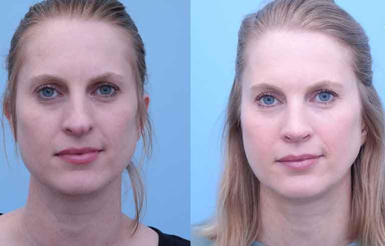 Rhinoplasty before and after photo by Midwest Facial Plastic Surgery in Minnesota