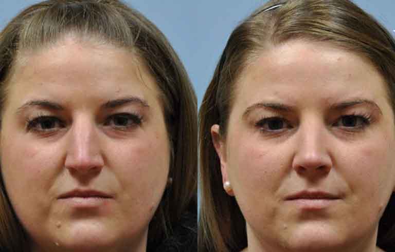 Rhinoplasty before and after photo by Midwest Facial Plastic Surgery in Minnesota